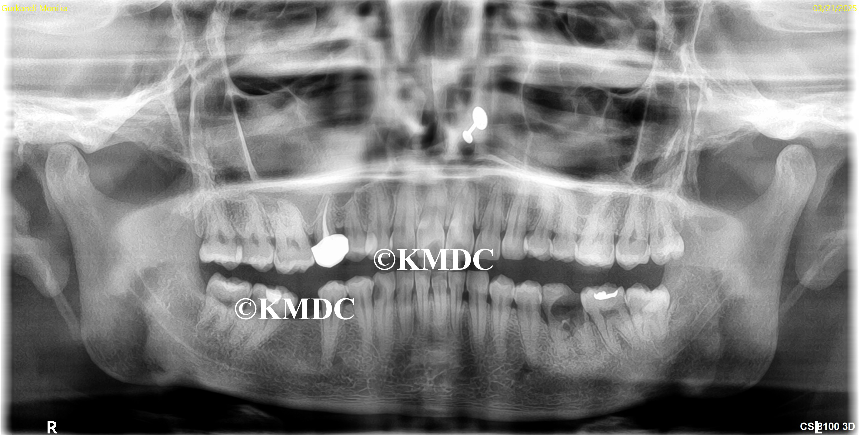 Case Study Gurkandi Monika